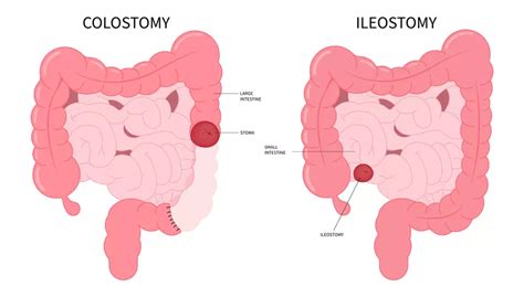 How To Dress With a Colostomy Bag: 7 Tips | MyCrohnsAndColitisTeam