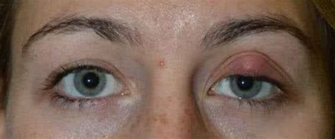 Chalazion Removal