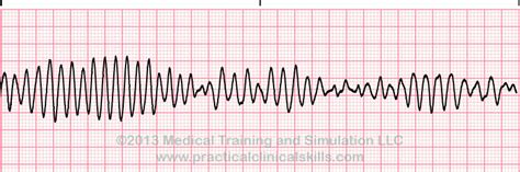 Ventricular Tachycardia Torsade de Pointes ECG Interpretation with Sample Strip