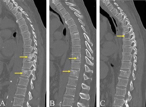 Sagittal computed tomography sections without contrast of the thoracic... | Download Scientific ...