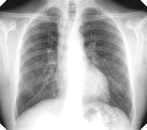 Silicosis chest x ray - wikidoc