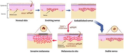 Benign Nevus Vs Melanoma