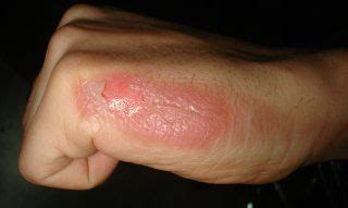 Itchy Fingers Causes, Pictures, Treatment | Healthhype.com