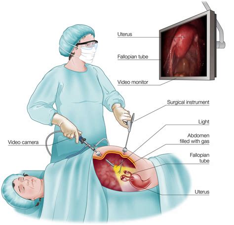 Laparotomy surgery, exploratory laparotomy or open laparotomy procedure