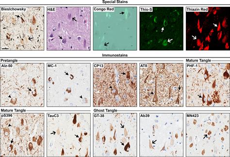 Visualization of neurofibrillary tangle maturity in Alzheimer's disease: A clinicopathologic ...