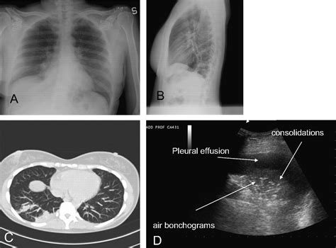 Lung ultrasound is an accurate diagnostic tool for the diagnosis of pneumonia in the emergency ...