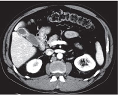 15 Adenomyomatosis of Gallbladder | Radiology Key