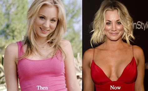 Kaley Cuoco Plastic Surgery Before and After Photos