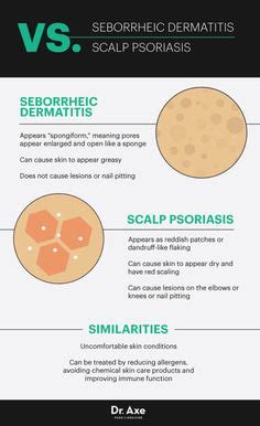 Seborrheic Dermatitis