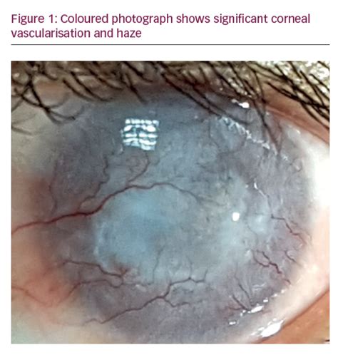 Extensive Corneal Neovascularisation Treatment by Ultraviolet Corneal ...