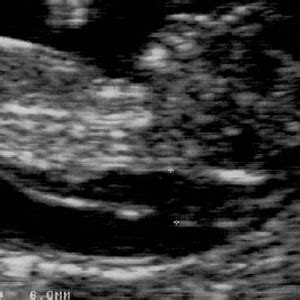 Nuchal translucency (NT) ultrasound - BabyCenter Canada