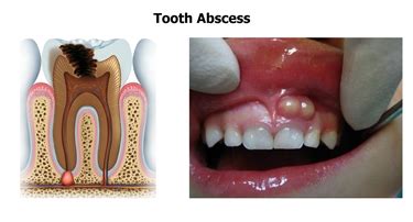 Ascesso al dente - Denti - Come guarire da un ascesso al dento