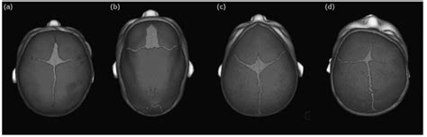 2: The normative and various forms of nonsynodromic CS observed at ...