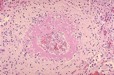 Renal Pathology