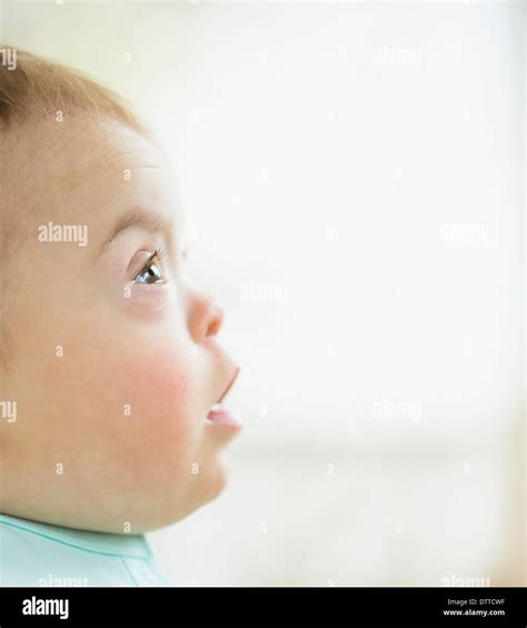 Caucasian baby girl with Down Syndrome Stock Photo - Alamy