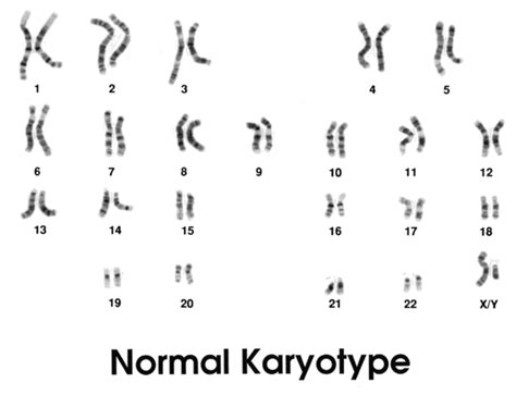 48,XXXY syndrome: MedlinePlus Genetics