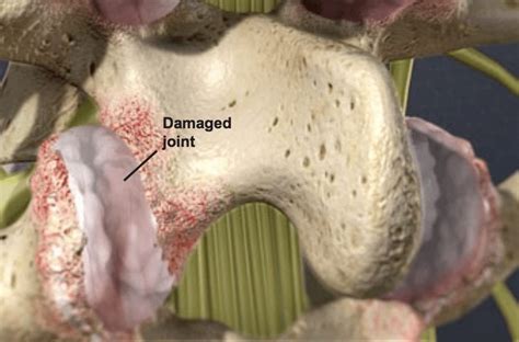 Facet Joint Syndrome - Important Information | Florida Surgery Consultants