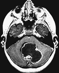 1 Cerebellar Juvenile Pilocytic Astrocytoma | Radiology Key