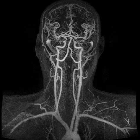 Discover the Intricacies of Brain Vessels with Magnetic Resonance Angiography