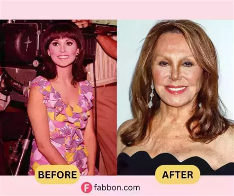 Marlo Thomas Plastic Surgery Secrets: Before And After Photos | Fabbon