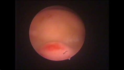 Prediction of Premalignant and Malignant Endometrial Polyps by Clinical and Hysteroscopic ...