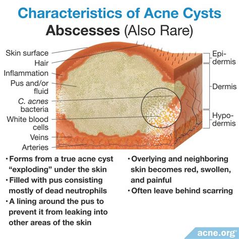 What Is an Acne Cyst? - Acne.org