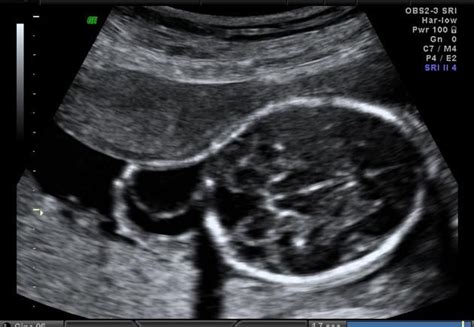 Cystic hygroma | Radiology Reference Article | Radiopaedia.org | Medical ultrasound, Ultrasound ...