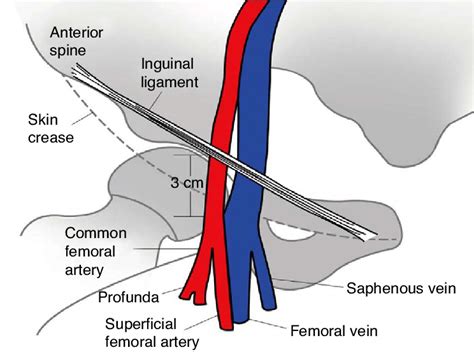 The anatomy relevant to percutaneous catheterization of the femoral... | Download Scientific Diagram