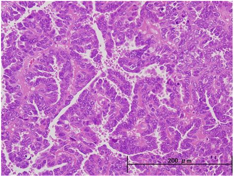 Cancers | Free Full-Text | Endometrial Serous Carcinoma: Its Molecular ...