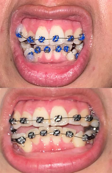 Braces: progress : r/Teeth