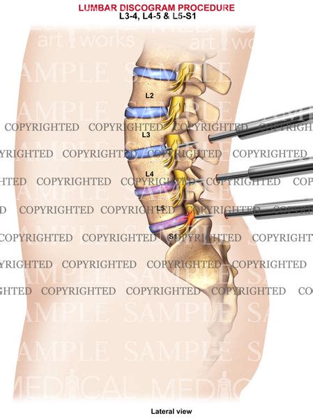 3 Level - Lumbar discogram procedure — Medical Art Works