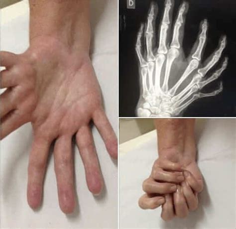 Have you heard on the ulnar dimelia or mirror hand syndrome