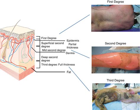 of Burn Injuries | Plastic Surgery Key