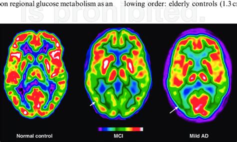 FDG-PET of control, MCI, and mild AD individuals. FDG-PET show reduced ...