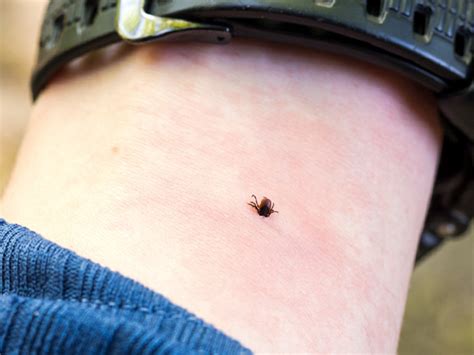 How Does A Tick Bite Look Like | Images and Photos finder