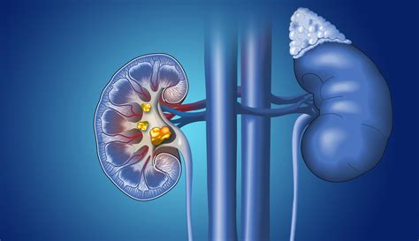 How Laser Lithotripsy Can Treat Patients With Kidney Stones - Z Urology