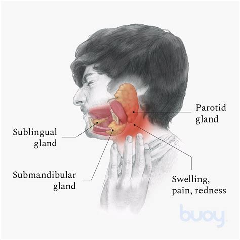 Swollen Salivary Gland Symptoms - Infoupdate.org