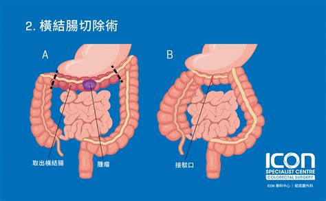 大腸切除術 — ICON專科中心