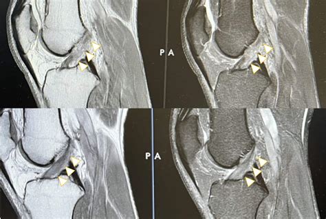 Healing Another ACL without Surgery - Regenexx