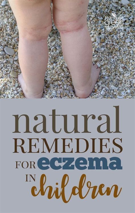 #Natural Remedies for Eczema in Children that clear it up quickly and completely… | Home ...