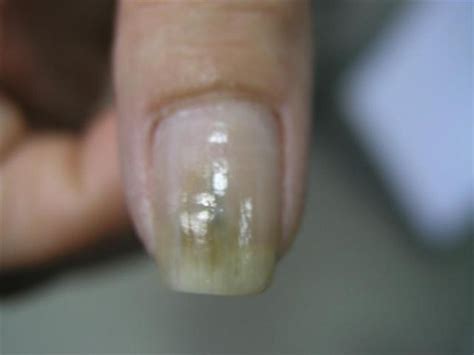 NAIL DISEASES - Pseudomonas aeruginosa infection of the nail picture | Hellenic Dermatological ...