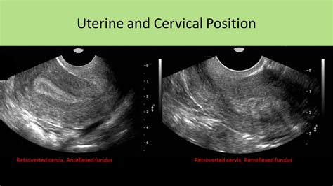 Retroverted Uterus Ultrasound