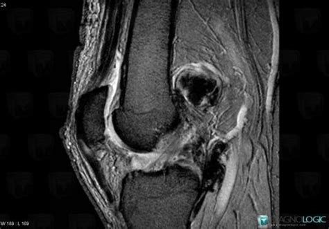 Radiology case : PVNS (MRI) - Diagnologic