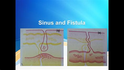 Sinus and Fistula - YouTube