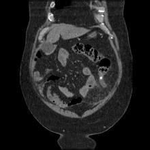 Appendix 0120 Luq Appendicitis With Fecalith | Surgery Photos