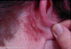 behind ear rash eczema | Ear health, Rashes, Treatment