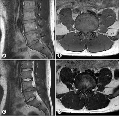 Lumbar Mri T1