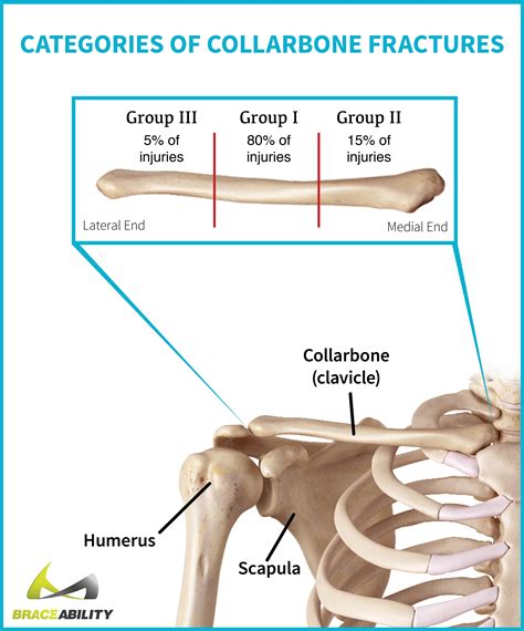 Clavicle Fractures | Broken Collarbone Symptoms, Causes & Treatment