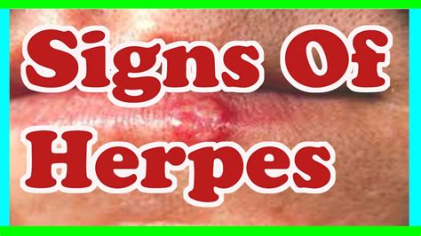 Symptoms Of Herpes Common Herpes Symptoms Youtube