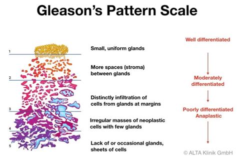 Gleason Score - ALTA Klinik